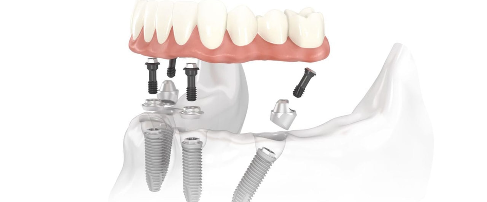 How Long Does it Take to Get All-on-Four Dental Implants?