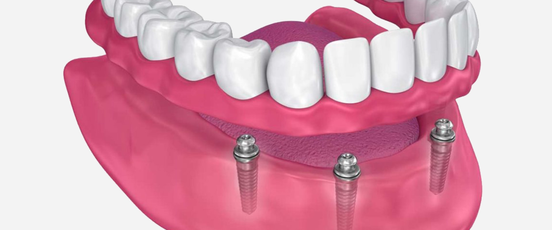 Can I Still Play Sports with My All-on-Four Dentures in Place?