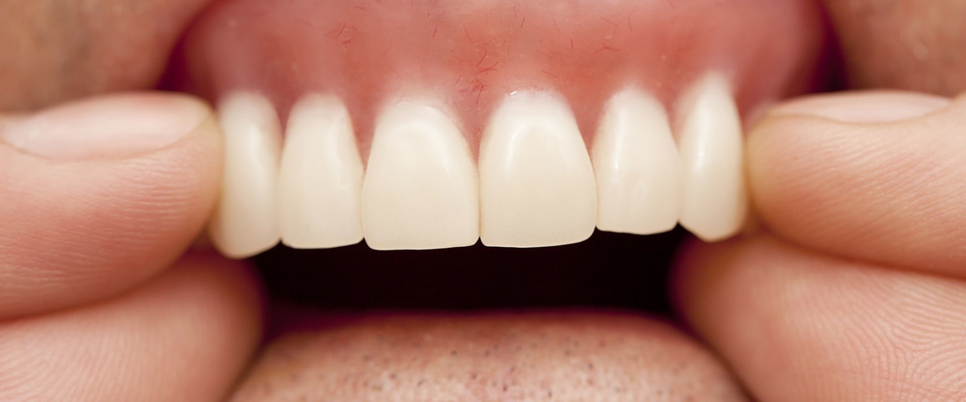 When Should You Replace Your Dentures?