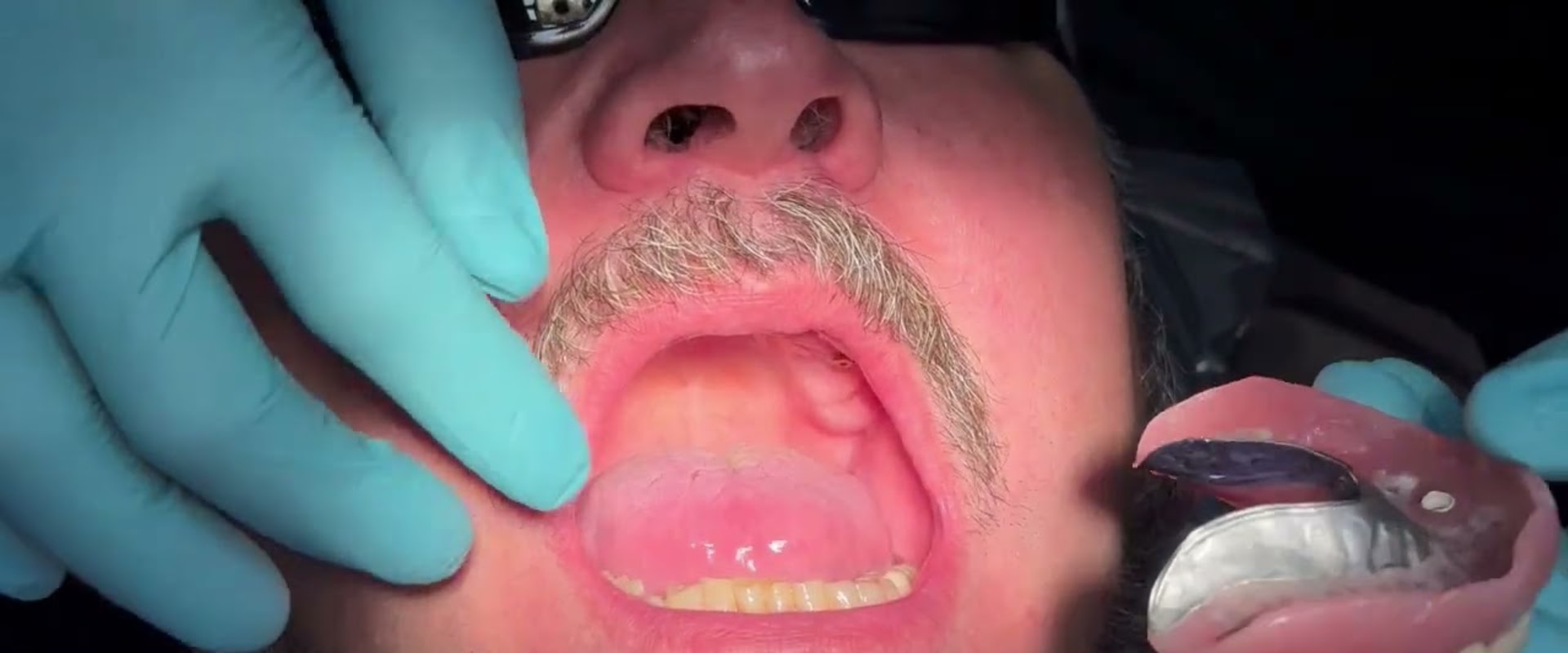 Complete Your Smile Makeover: Combining Invisalign And All-On-Four Dentures In Georgetown, TX