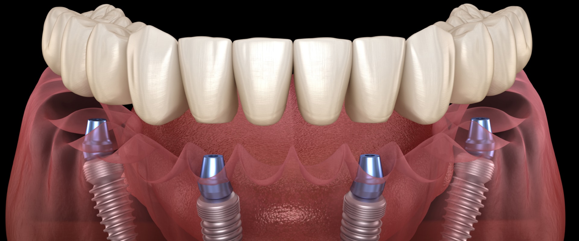 The Complete Guide To All-On-Four Dentures In London: Everything You Should Know