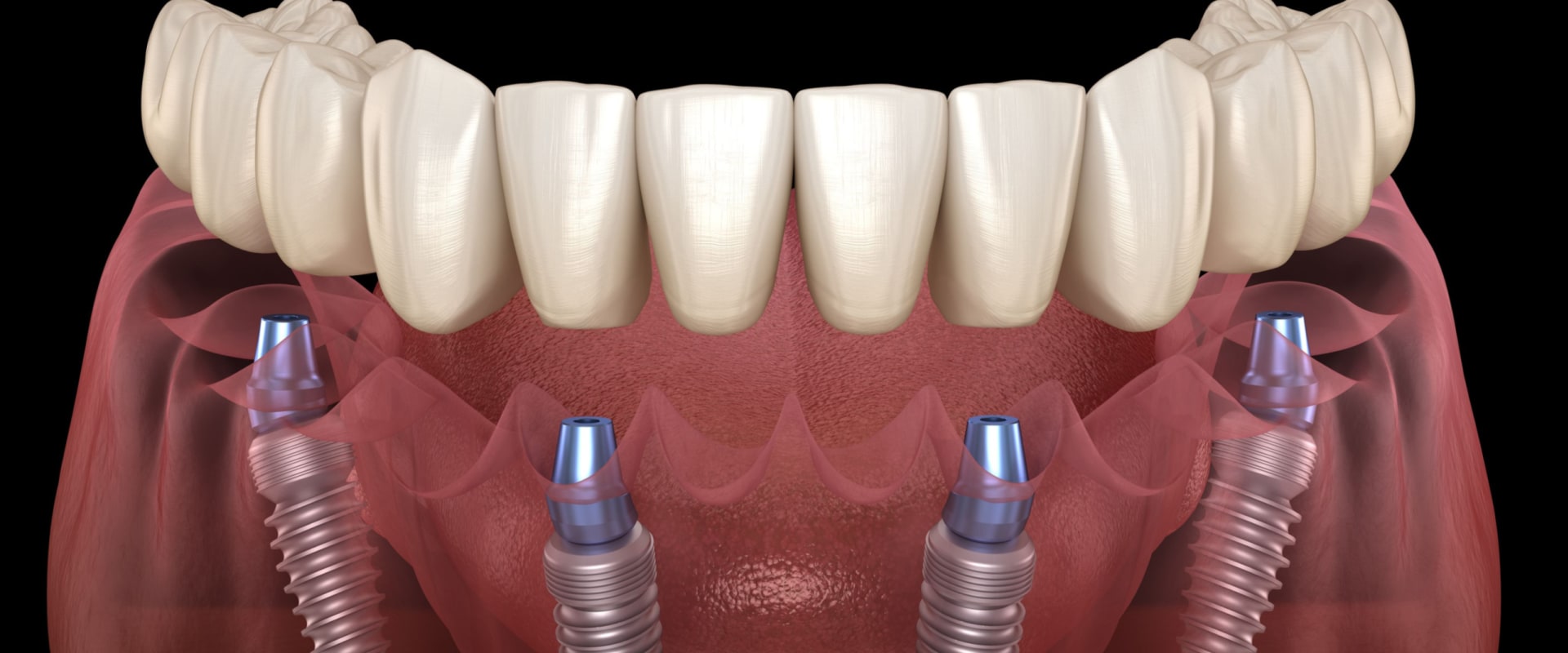 All-On-Four Dentures: A Game-Changer In Pediatric Dentistry In Gainesville
