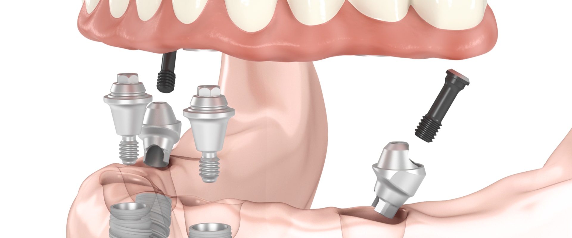 Revolutionize Your Dental Health: Exploring All-on-Four Dentures In Conroe, TX