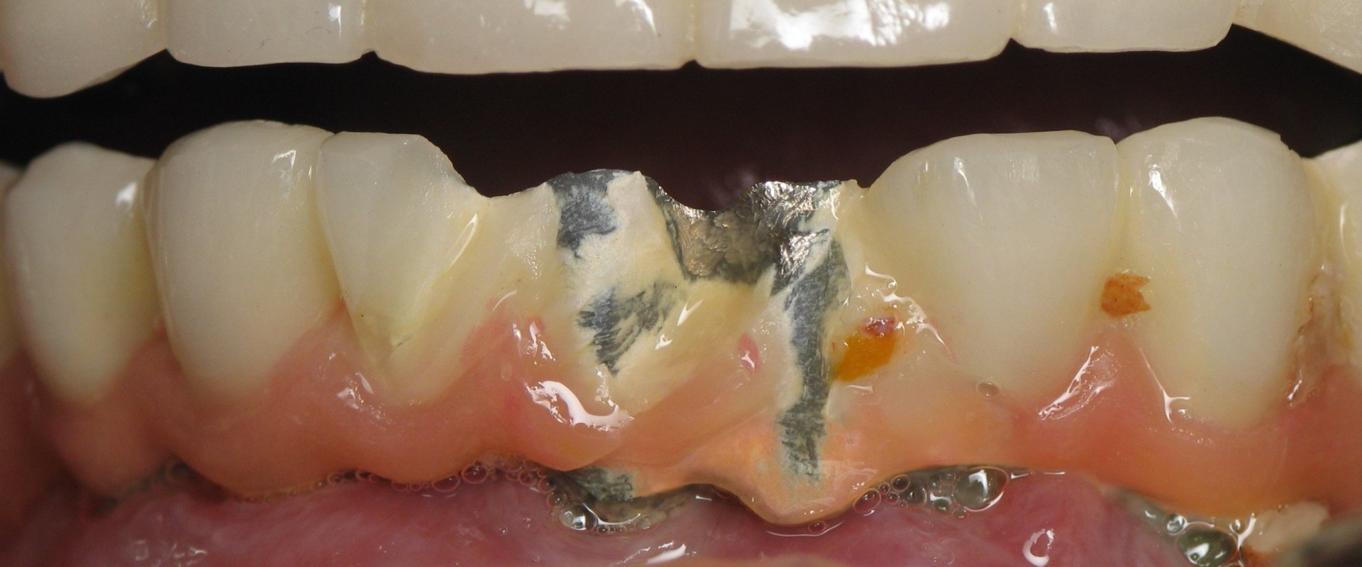 Can All-on-Four Dentures Be Repaired If They Break?