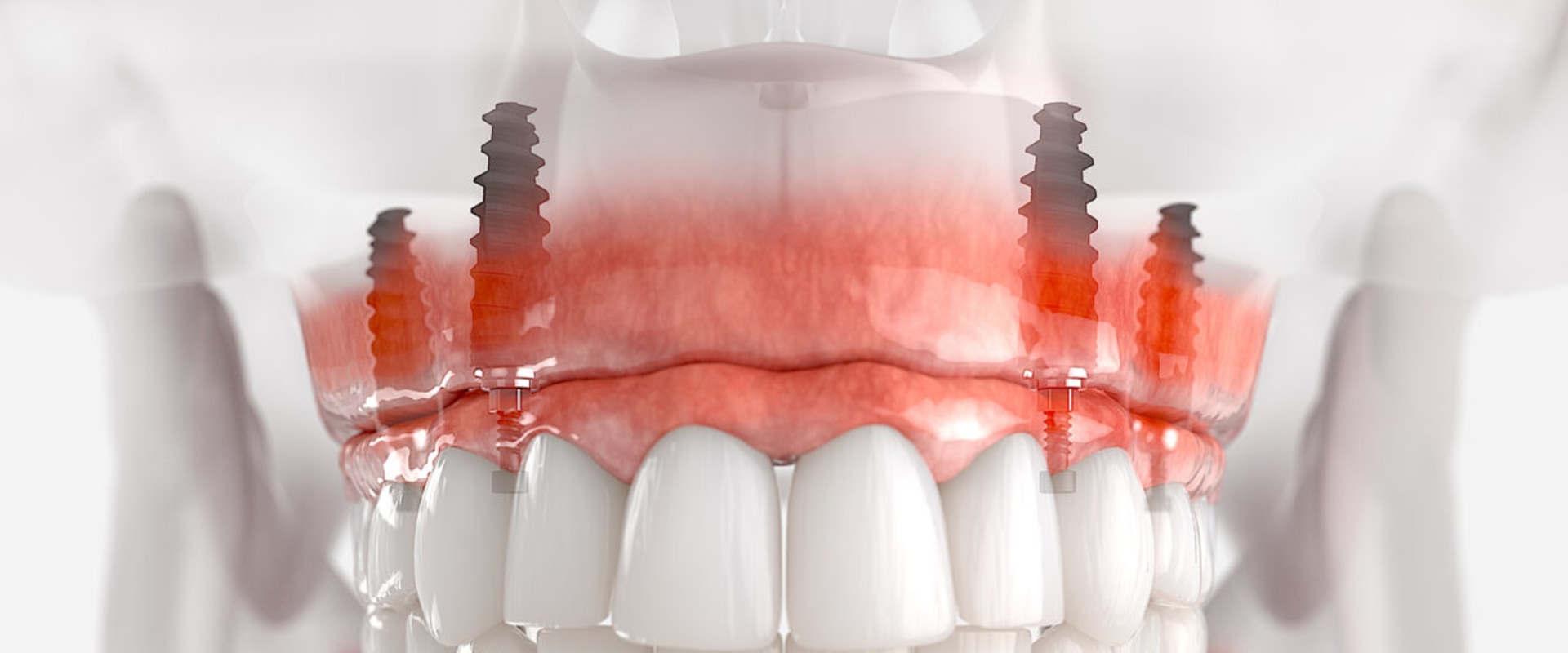 Restore Your Confidence With All-on-Four Dentures By Expert Dentists In McGregor, TX