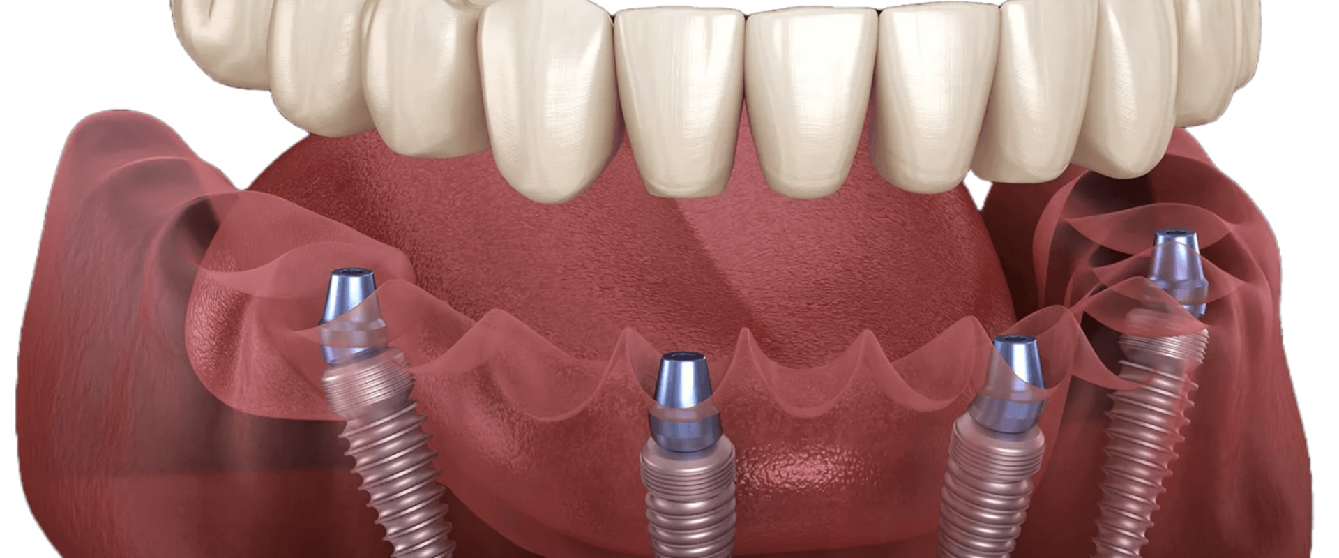 Revitalize Your Smile with All-on-Four Dentures in Kilchberg