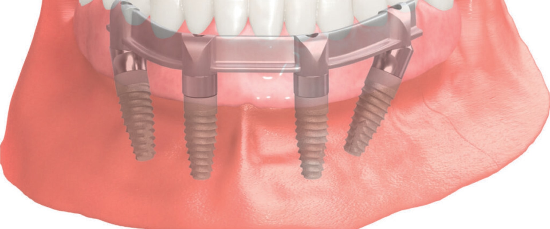 Smile Confidently Again With All-On-Four Dentures In Waco, TX