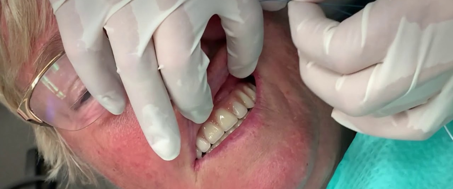 Brushing and Flossing with All on Four Dental Implants