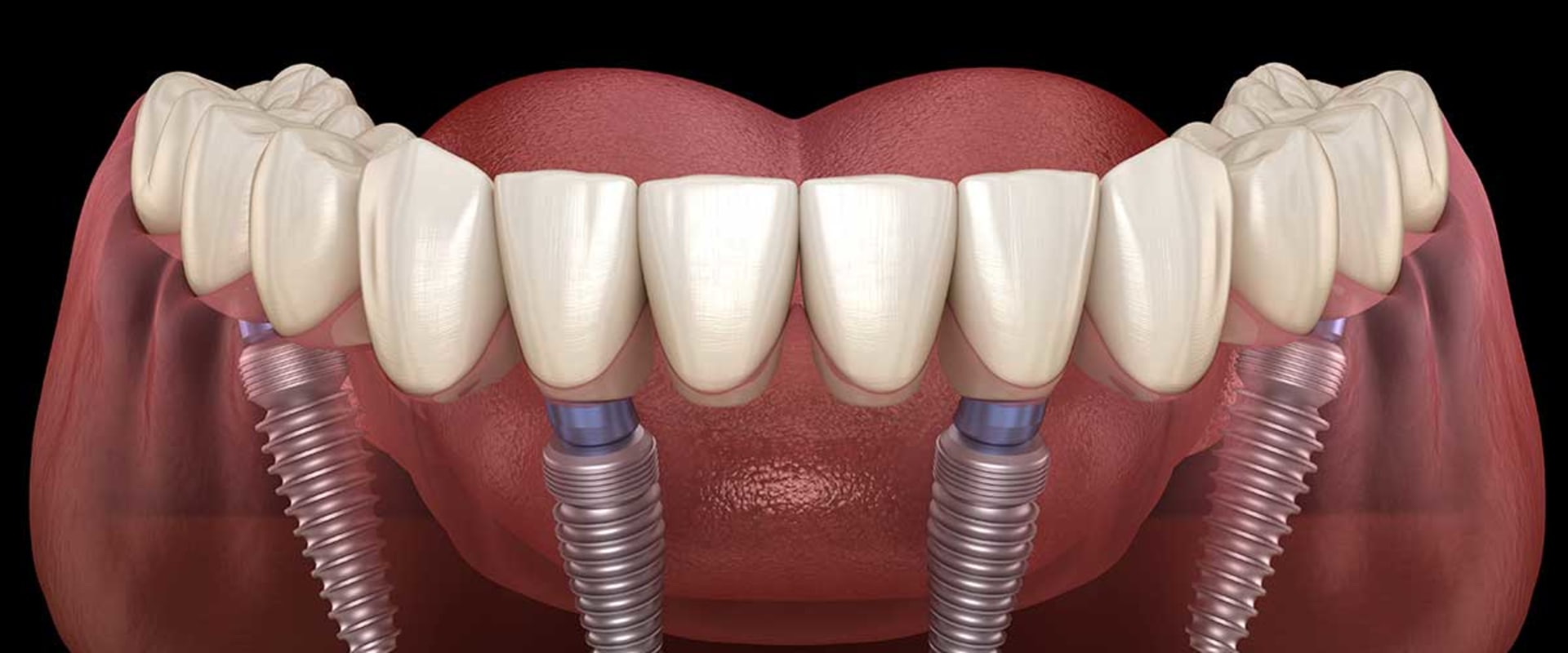 What Type of Anesthesia is Used for All-on-Four Dental Implants?