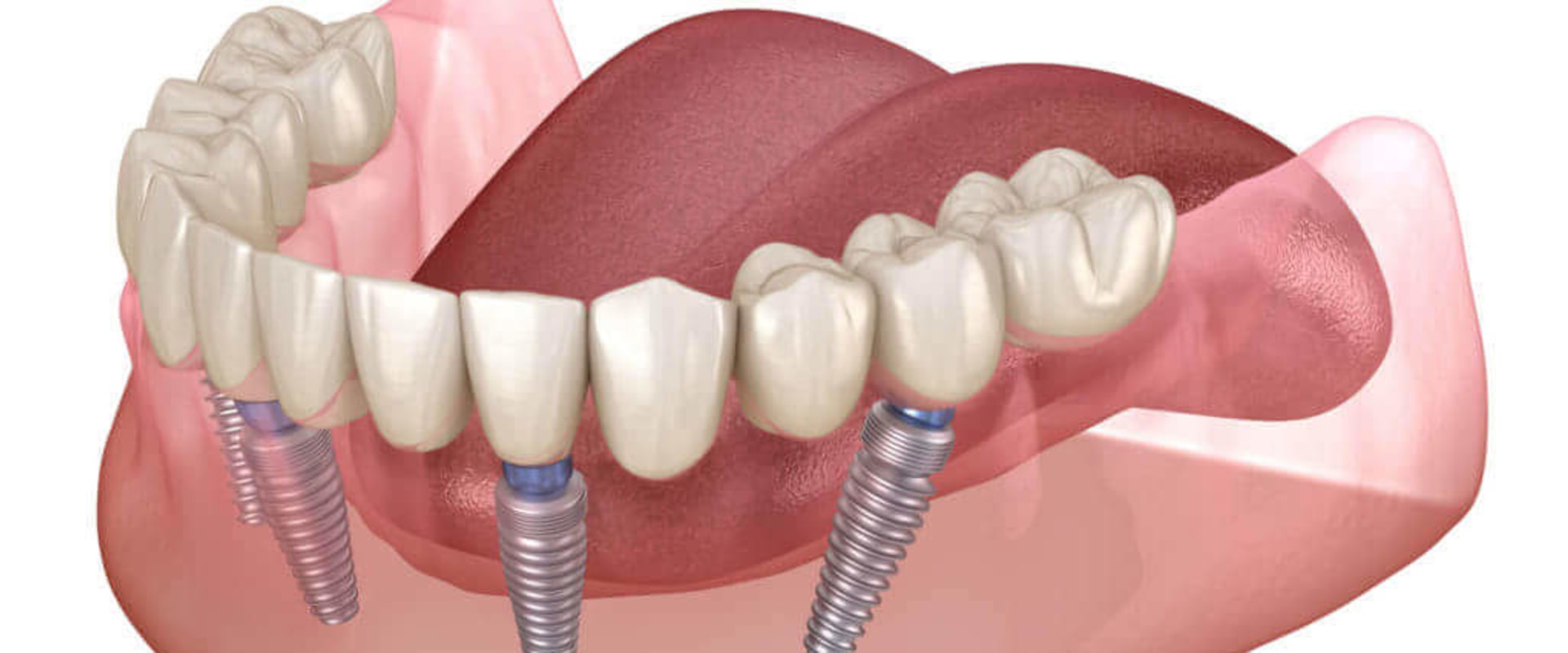 Can All-on-Four Dental Implants Be Whitened?