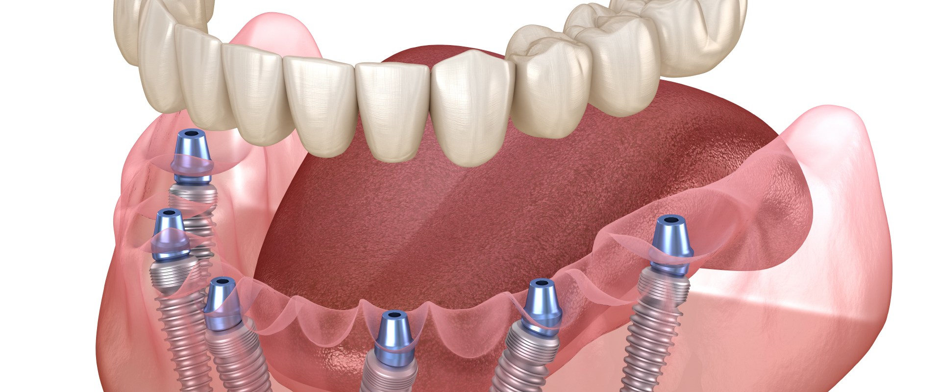 What Type of Denture Makes Patients the Happiest?