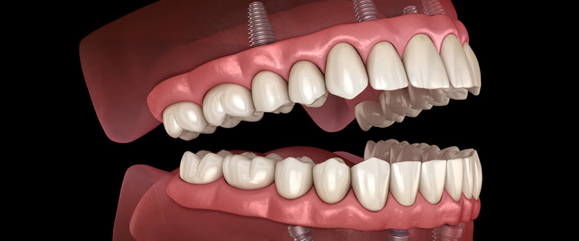 Can I Still Eat Normally with All-on-Four Dentures?