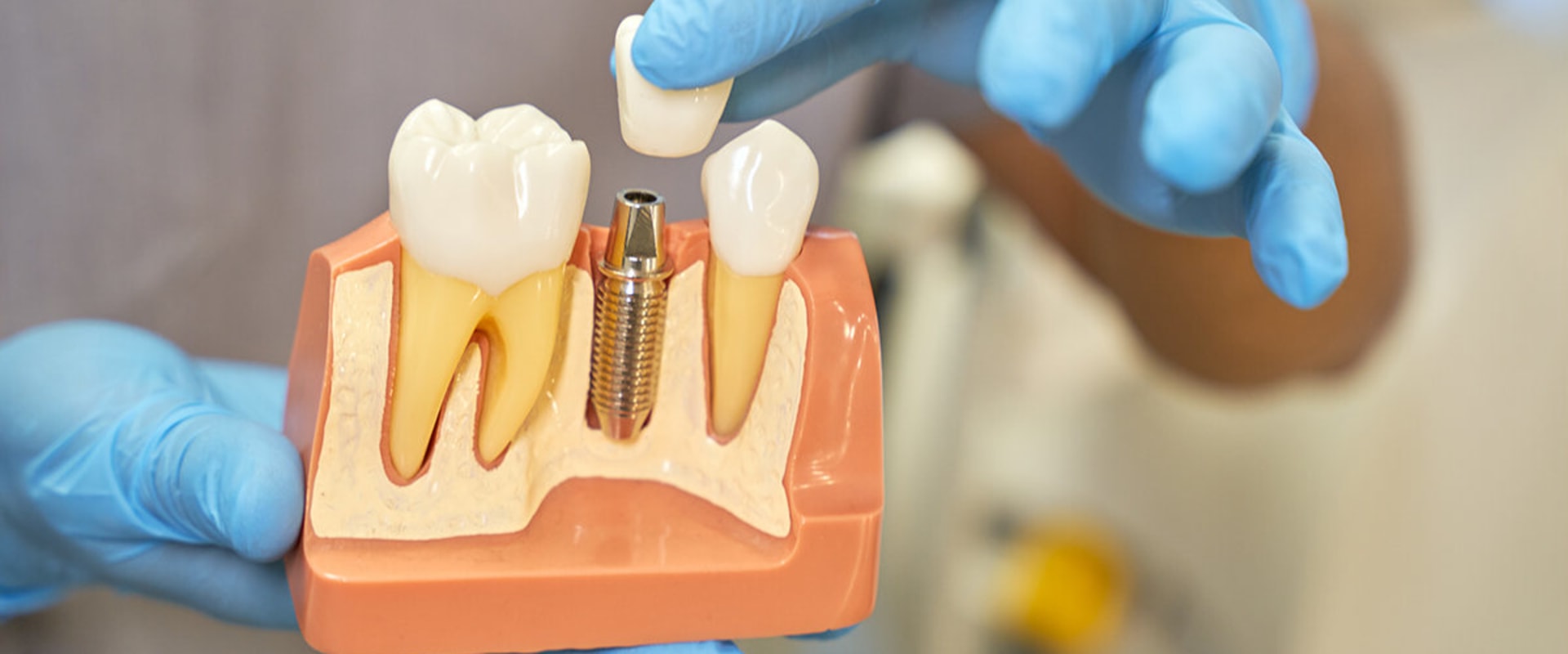 Why Temporary Prosthetics Are an Important Part of the All-on-Four Process