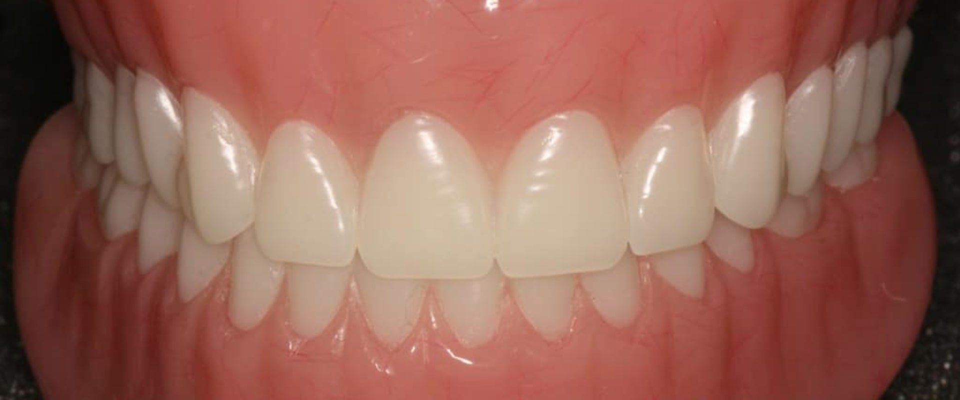 Can Dentures Be Adjusted to Fit Tighter?