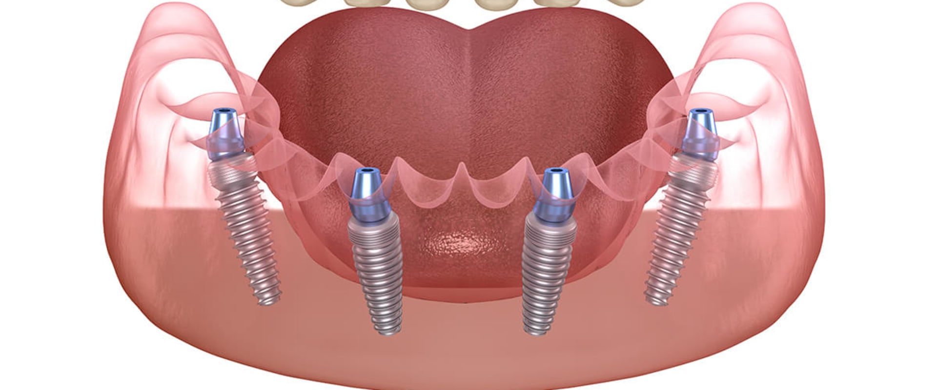 What Are the Risks of All-on-Four Dental Implants?