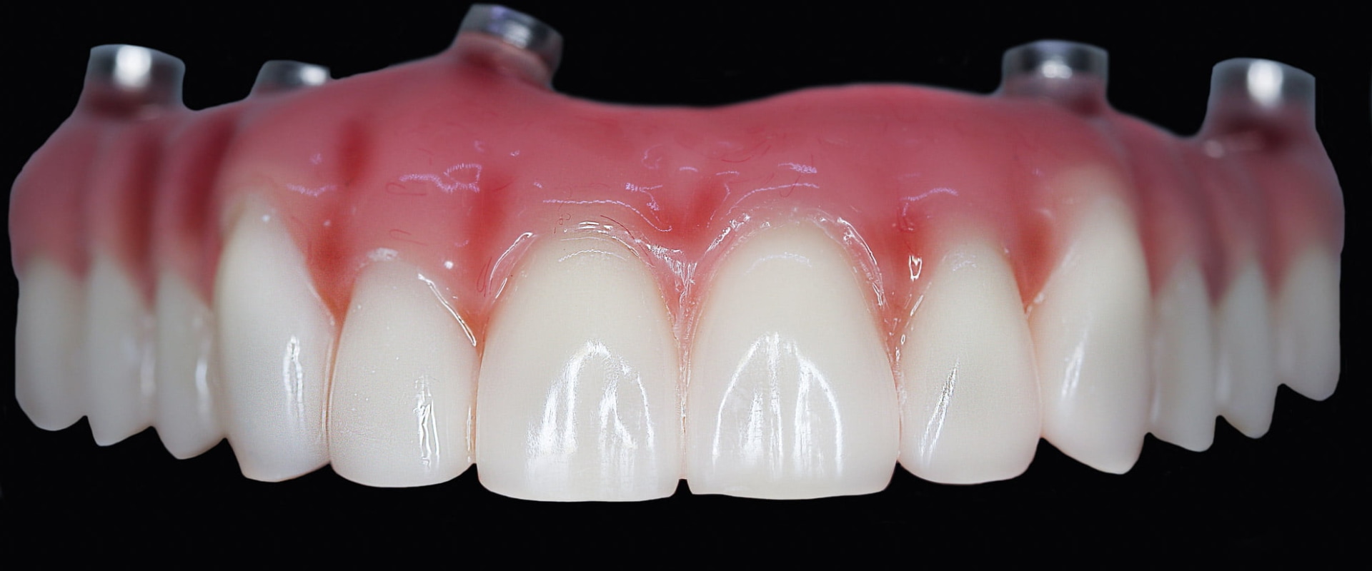Why More And More People Are Opting For All-on-Four Dentures In Sydney