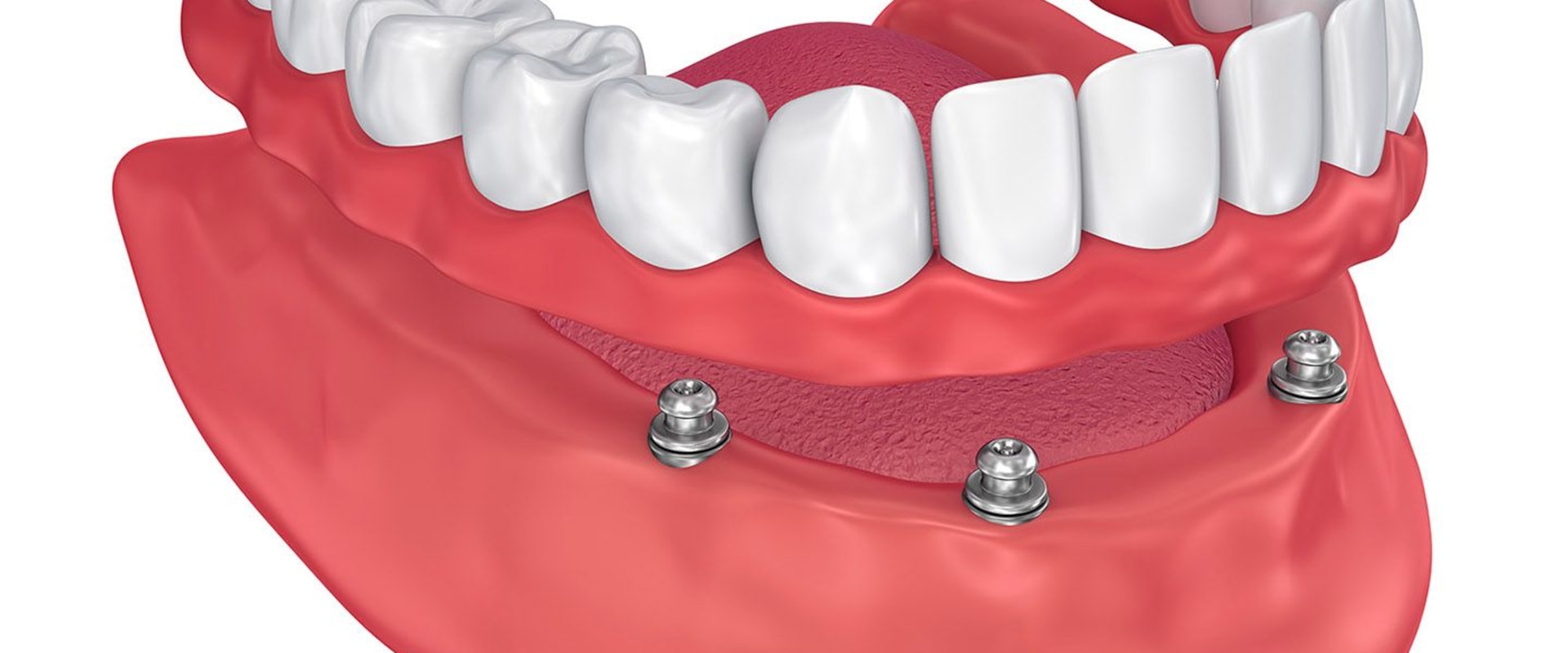 Can All-on-Four Dentures Be Adjusted?