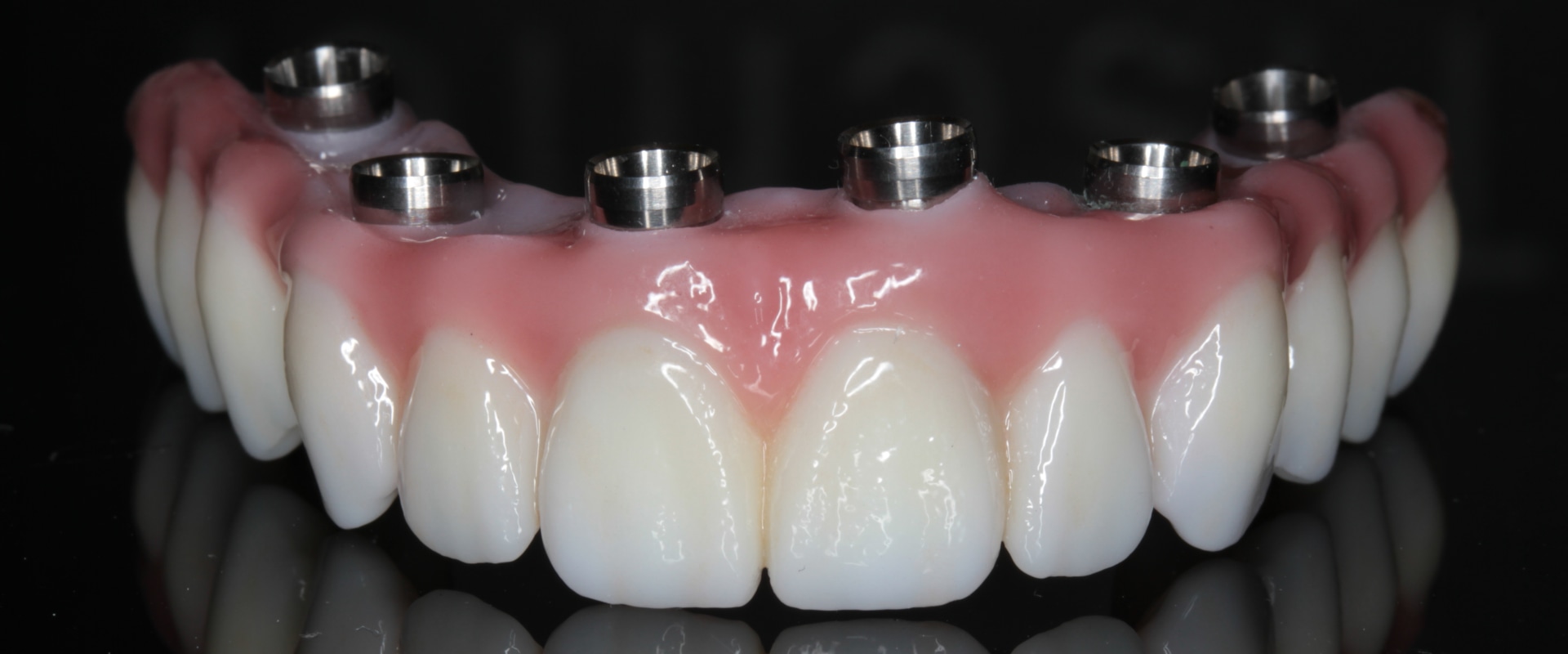 Do I Need to See a Dentist Regularly if I Have All on Four Dentures?