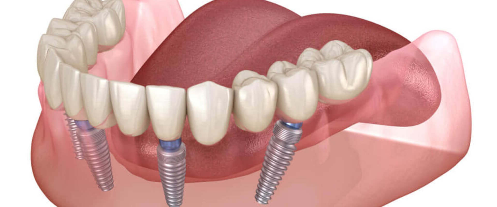 Will All-on-Four Dentures Feel Natural in Place?