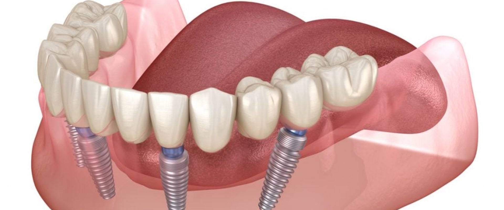 Recovering from All-on-Four Dental Implants: How Long Does It Take?