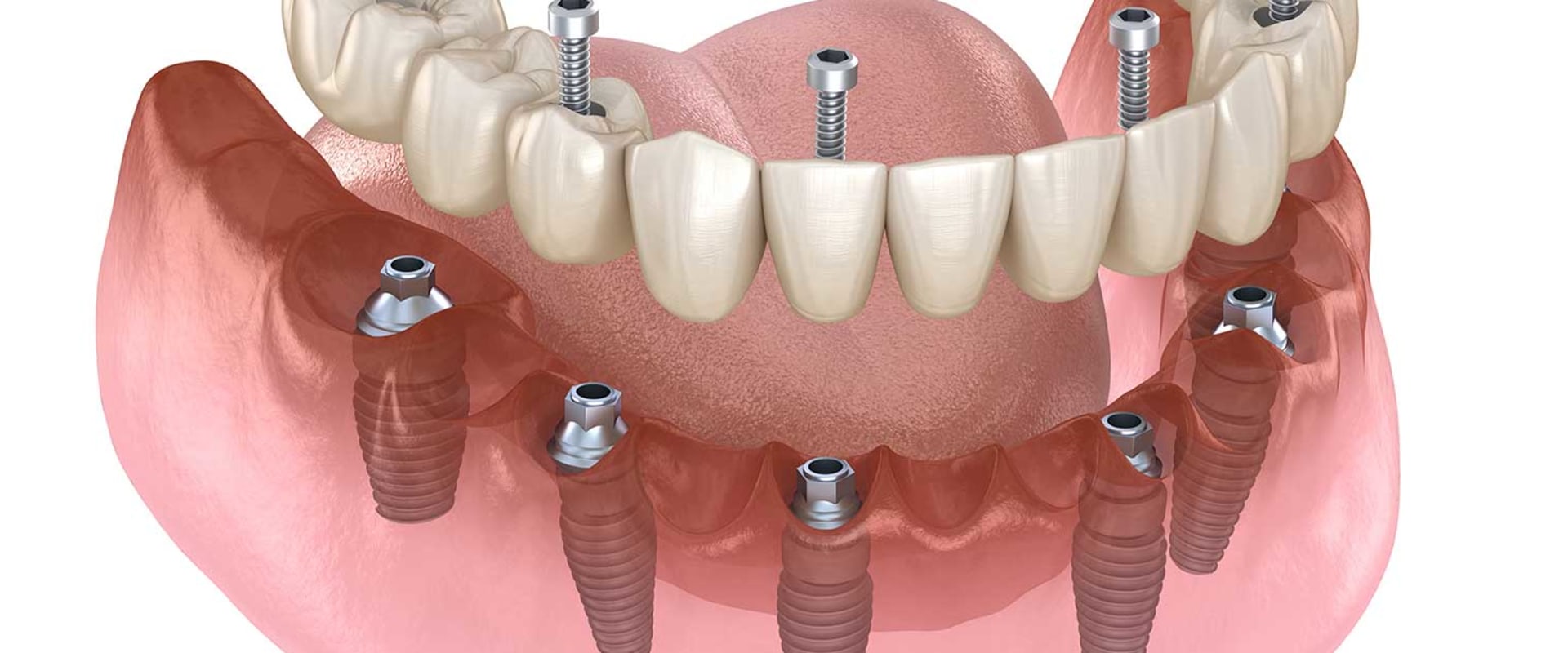Making The Right Choice: How To Find The Best Dentist For All-On-Four Dentures In Monroe