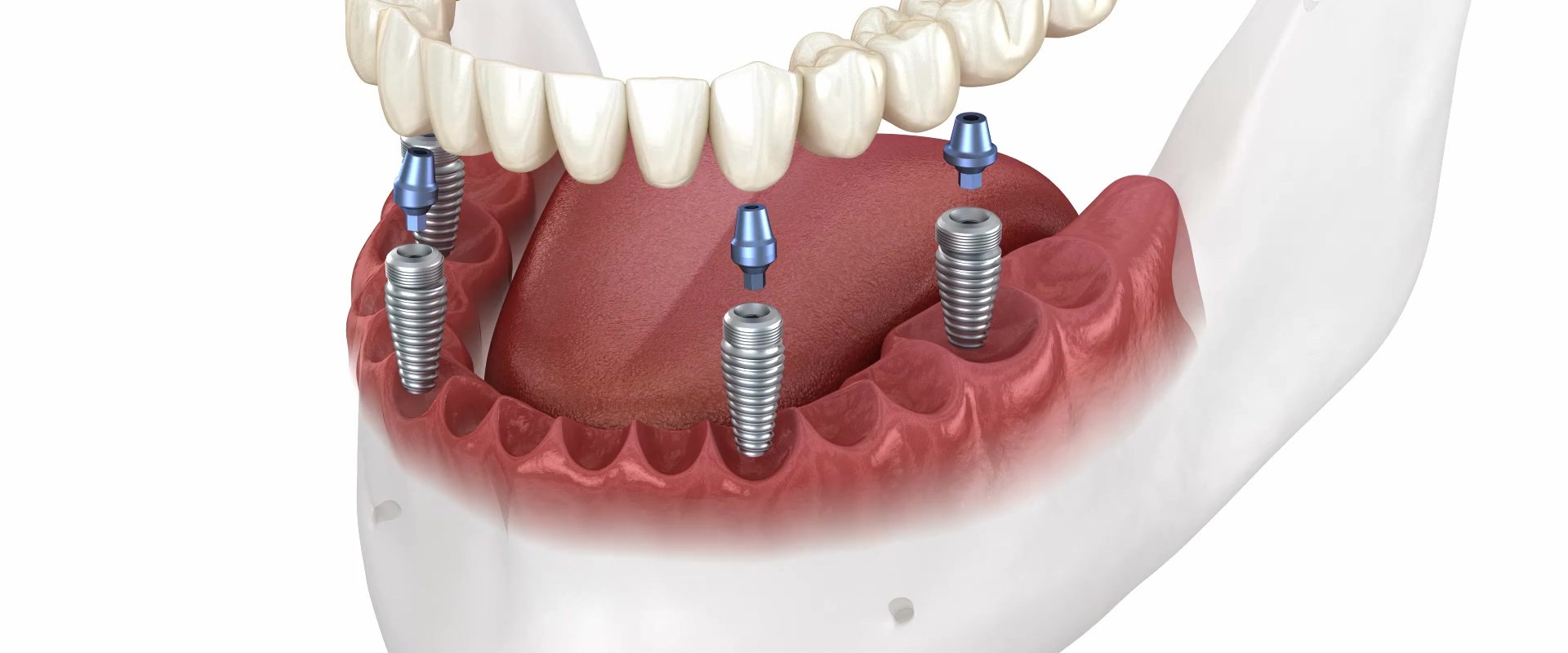 All-on-Four Dentures And Veneers In Round Rock: How They Can Transform Your Smile And Boost Your Confidence