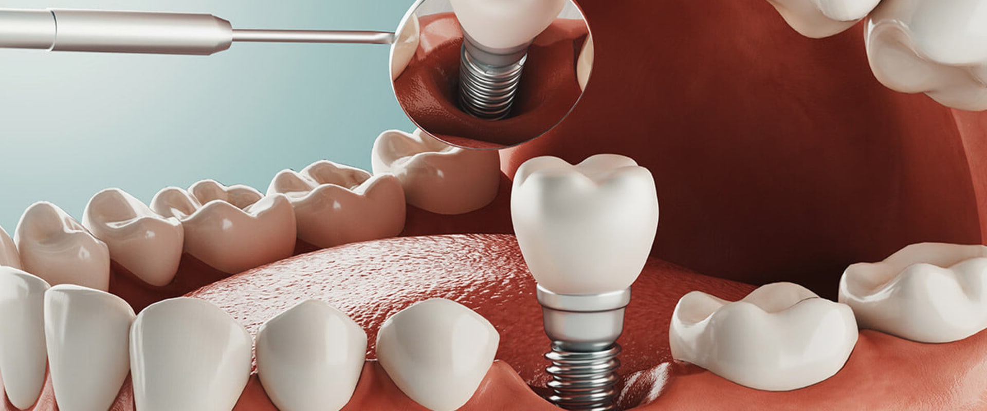 Exploring Alternatives to All-on-Four Dental Implants