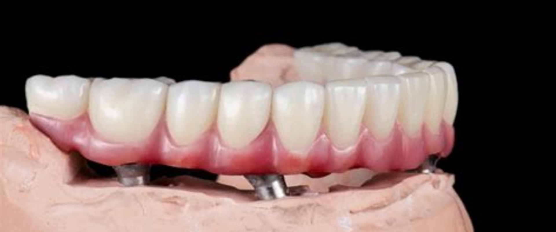 The Hidden Challenges of Adapting to Full-Arch Implant-Supported Dentures