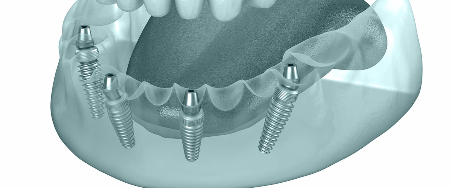 The Role Of Children’s Emergency Dentists In Basel With All-on-four Dentures