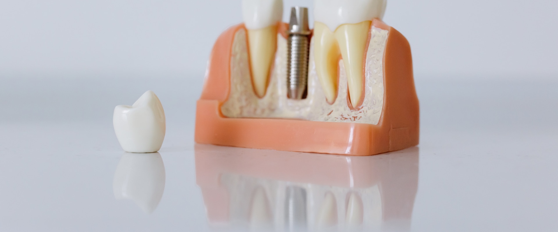 Revolutionizing Tooth Replacement: Mcgregor's All-on-four Dentures And Dental Implants
