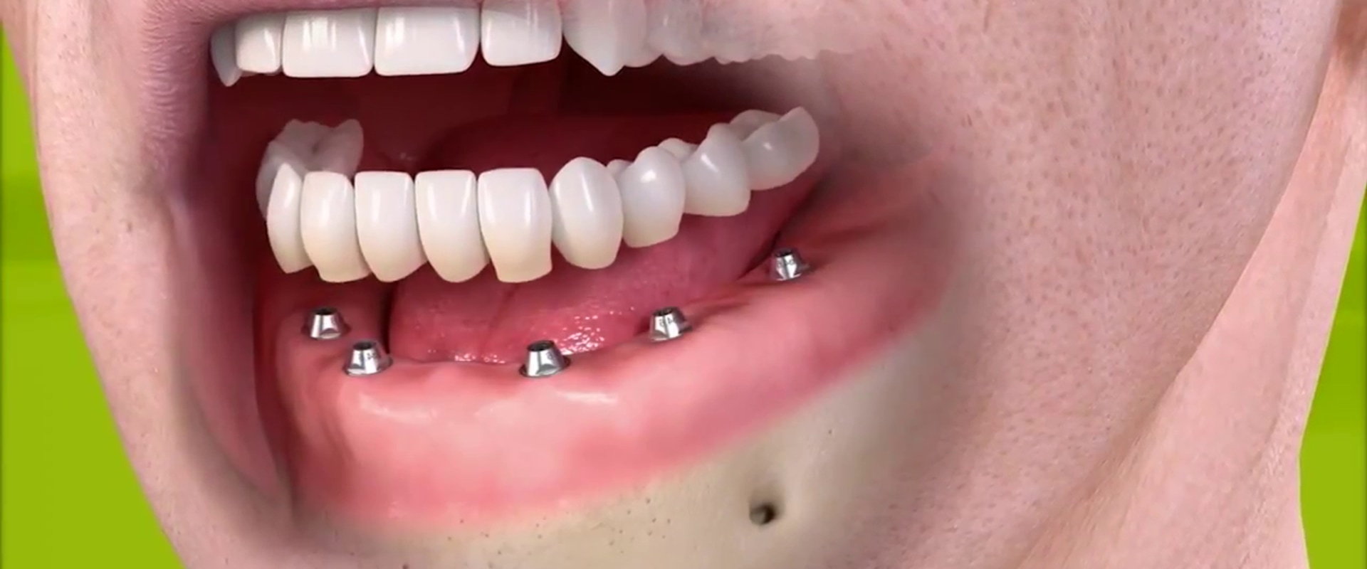 Will My Gums Be Visible When I Wear My All-on-Four Dentures in Place?