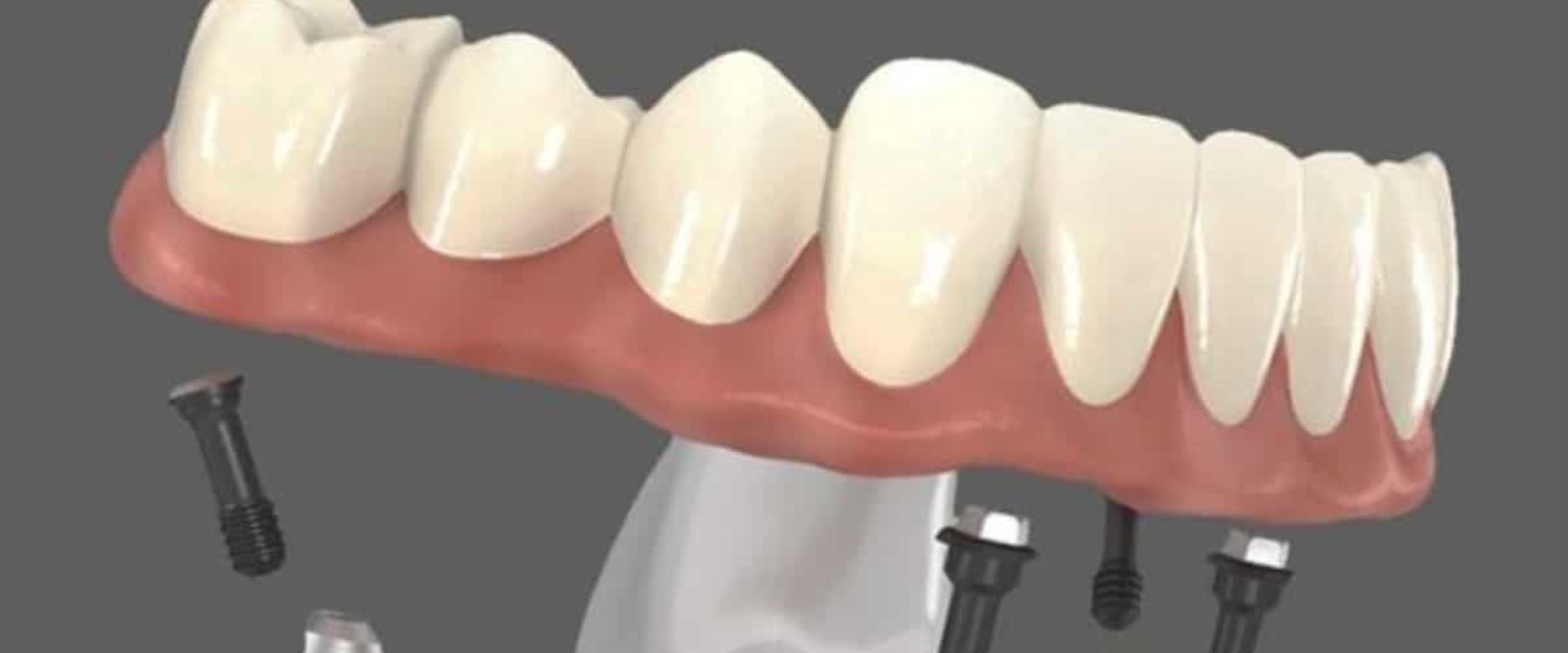 Recovery Timeline After Receiving All-on-Four Dentures