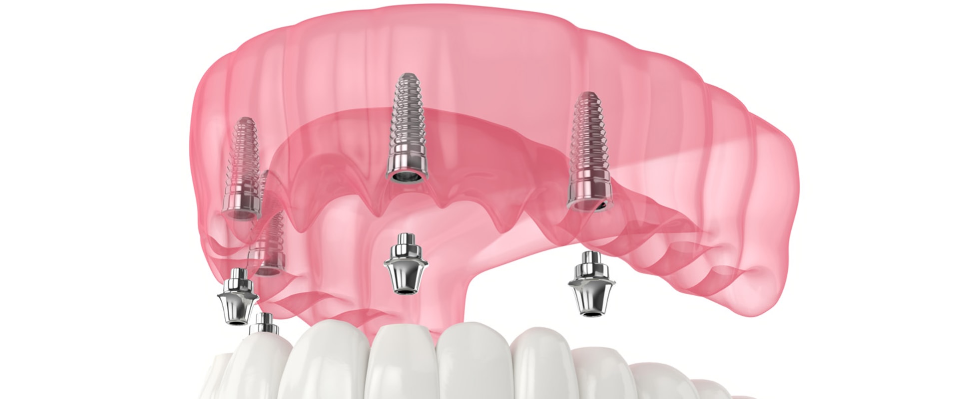All-On-4 Dental Implants Vs. All-On-4 Dentures: Which Is Right For You In Honolulu