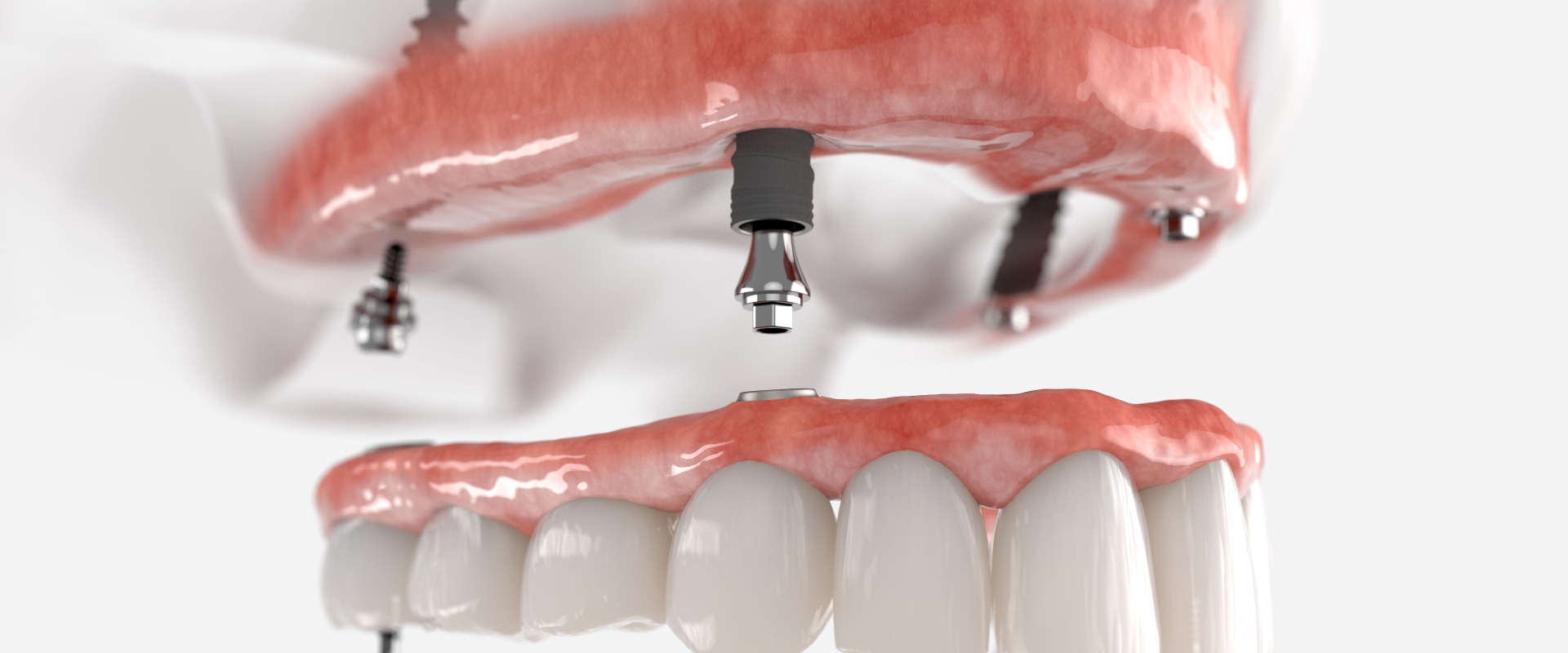 What is the Difference Between Snap-in Dentures and All-on-4 Implants?