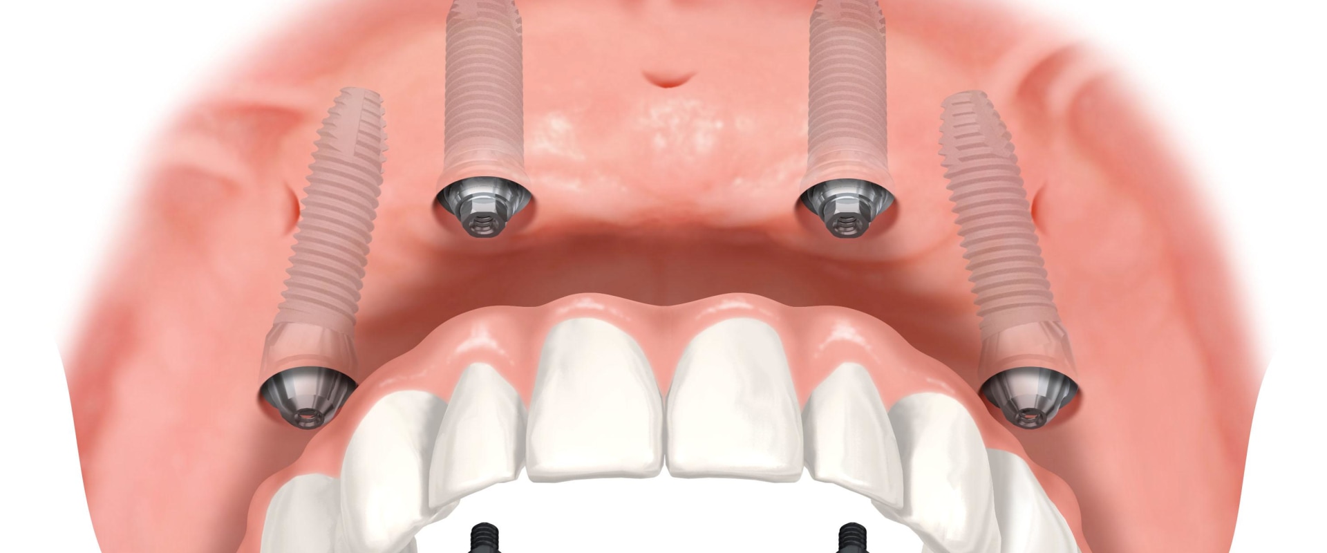 Transforming Smiles In Pflugerville, TX: How Invisalign Works Together With All-On-Four Dentures For Optimal Results