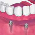Can I Still Play Sports with My All-on-Four Dentures in Place?