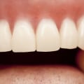 When Should You Replace Your Dentures?