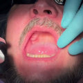 Complete Your Smile Makeover: Combining Invisalign And All-On-Four Dentures In Georgetown, TX