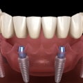 The Complete Guide To All-On-Four Dentures In London: Everything You Should Know