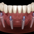 All-On-Four Dentures: A Game-Changer In Pediatric Dentistry In Gainesville