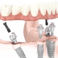 Revolutionize Your Dental Health: Exploring All-on-Four Dentures In Conroe, TX