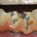 Can All-on-Four Dentures Be Repaired If They Break?