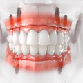 Restore Your Confidence With All-on-Four Dentures By Expert Dentists In McGregor, TX