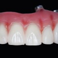 Enhance Your Quality Of Life With All-On-Four Dentures: A Holistic Approach In Sydney Dentistry