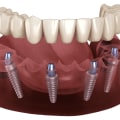 Revitalize Your Smile with All-on-Four Dentures in Kilchberg