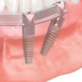 Smile Confidently Again With All-On-Four Dentures In Waco, TX