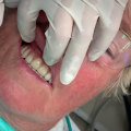 Brushing and Flossing with All on Four Dental Implants