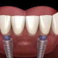 What Type of Anesthesia is Used for All-on-Four Dental Implants?