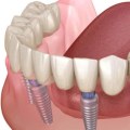 Can All-on-Four Dental Implants Be Whitened?