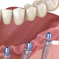 What Type of Denture Makes Patients the Happiest?